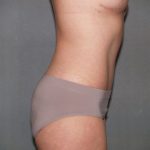 Tummy Tuck Before & After Patient #2368