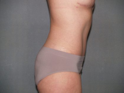 Tummy Tuck Before & After Patient #2368