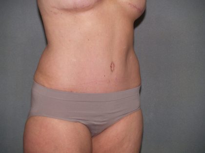 Tummy Tuck Before & After Patient #2368