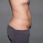 Tummy Tuck Before & After Patient #2368