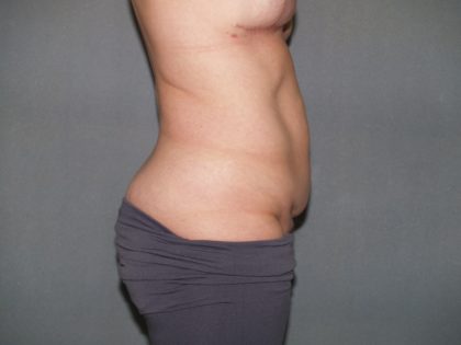 Tummy Tuck Before & After Patient #2368