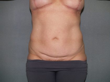 Tummy Tuck Before & After Patient #2368