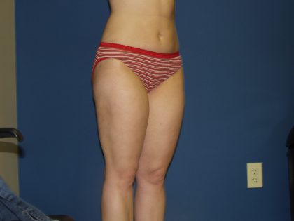 Liposuction Before & After Patient #3854