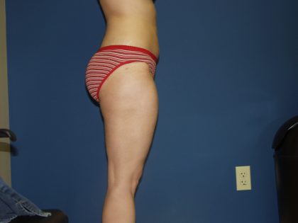 Liposuction Before & After Patient #3854