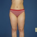 Liposuction Before & After Patient #3854