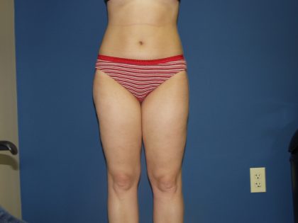 Liposuction Before & After Patient #3854