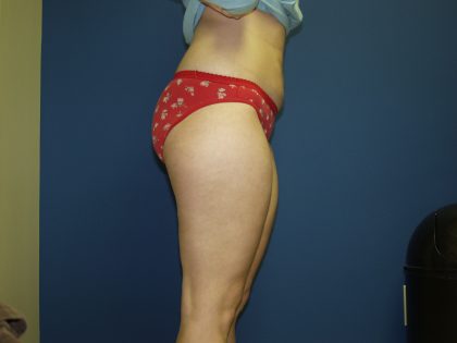 Liposuction Before & After Patient #3854