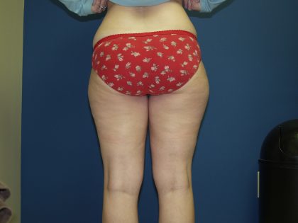 Liposuction Before & After Patient #3854