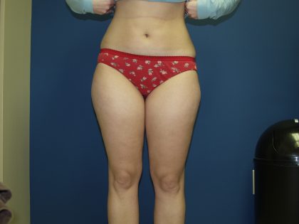 Liposuction Before & After Patient #3854