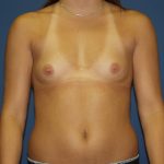 Breast Augmentation Before & After Patient #2934