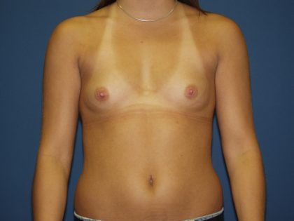 Breast Augmentation Before & After Patient #2934