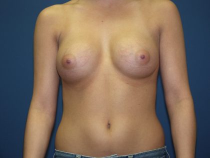Breast Augmentation Before & After Patient #2934