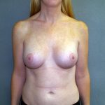 Breast Lift with Implant Before & After Patient #1537