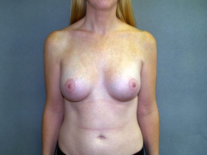 Breast Lift with Implant Before & After Patient #1537