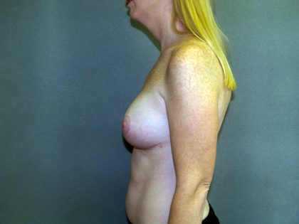 Breast Lift with Implant Before & After Patient #1537