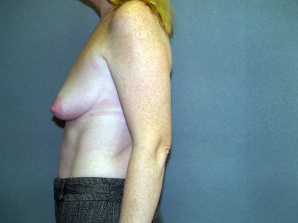 Breast Lift with Implant Before & After Patient #1537
