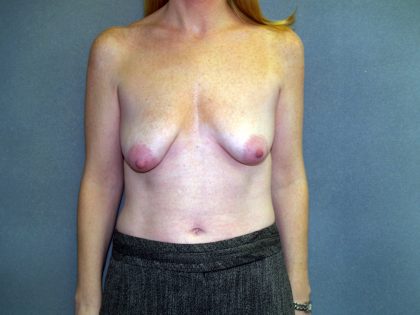 Breast Lift with Implant Before & After Patient #1537