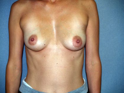 Breast Lift with Implant Before & After Patient #1696