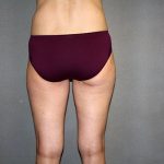 Liposuction Before & After Patient #3674