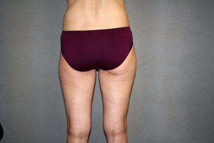 Liposuction Before & After Patient #3674