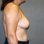 Breast Reduction Before & After Patient #3483
