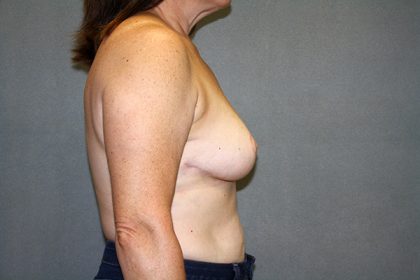 Breast Reduction Before & After Patient #3483