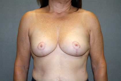 Breast Reduction Before & After Patient #3483