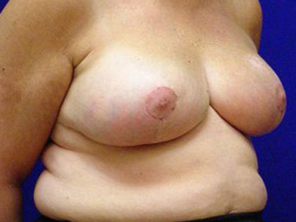 Breast Reduction Before & After Patient #3517