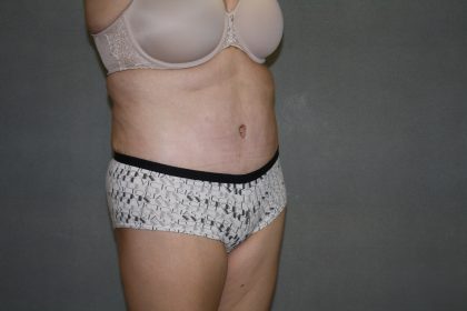 Tummy Tuck Before & After Patient #2161