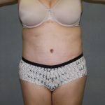 Tummy Tuck Before & After Patient #2161