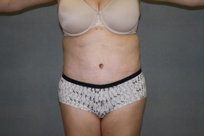 Tummy Tuck Before & After Patient #2161