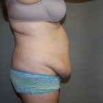 Tummy Tuck Before & After Patient #2161