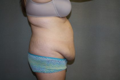 Tummy Tuck Before & After Patient #2161