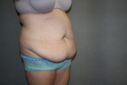 Tummy Tuck Before & After Patient #2161