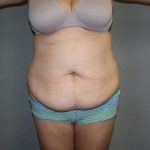 Tummy Tuck Before & After Patient #2161