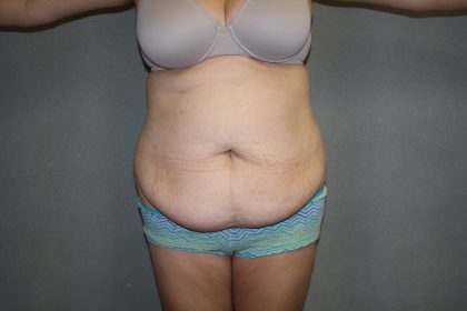 Tummy Tuck Before & After Patient #2161