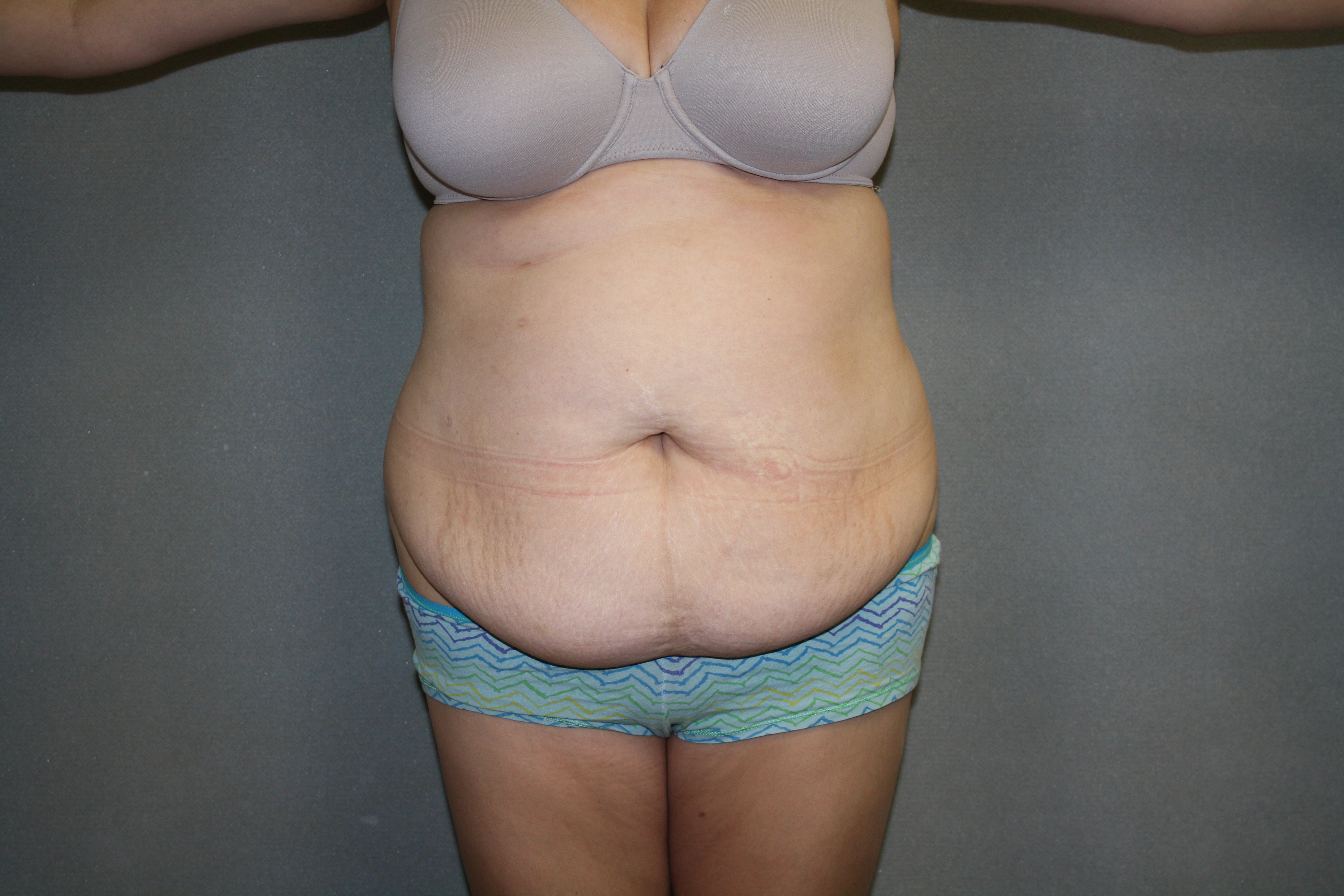 Tummy Tuck Before & After Patient #2161