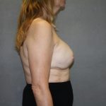 Breast Reconstruction Before & After Patient #2337