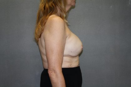 Breast Reconstruction Before & After Patient #2337