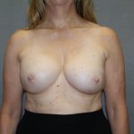 Breast Reconstruction Before & After Patient #2337