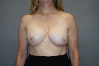 Breast Reconstruction Before & After Patient #2337