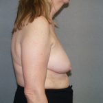 Breast Reconstruction Before & After Patient #2337