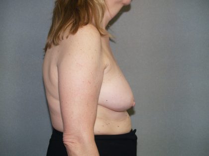 Breast Reconstruction Before & After Patient #2337