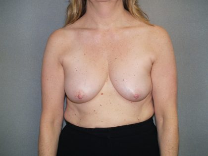 Breast Reconstruction Before & After Patient #2337