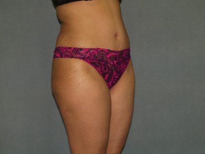 Tummy Tuck Before & After Patient #1919