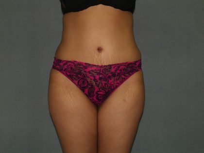 Tummy Tuck Before & After Patient #1919