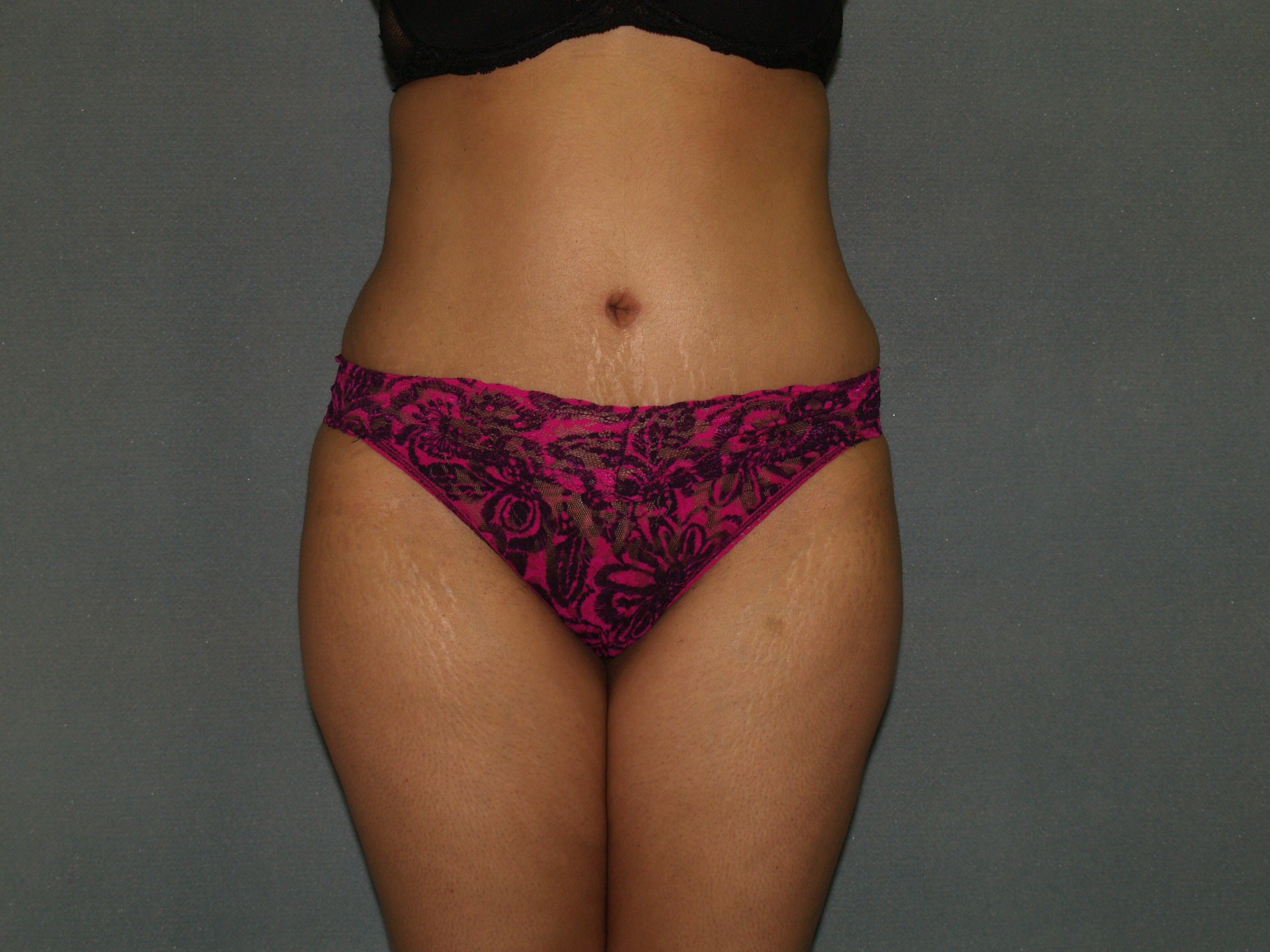 Tummy Tuck Before & After Patient #1919