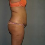 Tummy Tuck Before & After Patient #1919