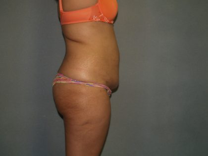 Tummy Tuck Before & After Patient #1919
