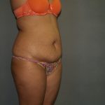 Tummy Tuck Before & After Patient #1919